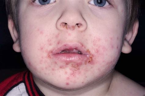 Röda prickar runt munnen barn allergi